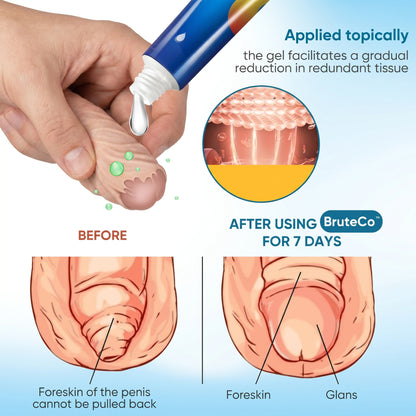 SmoothCare Gel (Redundant Prepuce Corrector Gel)